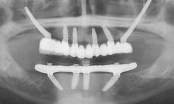 All-on-4 ve Zygoma İmplant Tedavisi Nedir?
