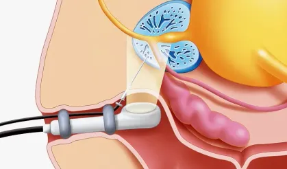 Prostat Biyopsisi Nedir?