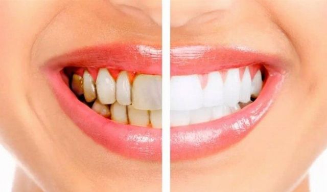 Diş taşı temizliğinin zararı var mı?